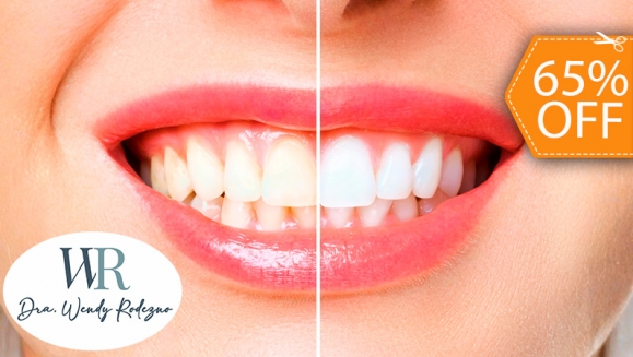 [Image: ¡Paga $55 en Lugar de $155 por 2 Aplicaciones de Blanqueamiento Dental con Luz LED + Limpieza Dental!m]