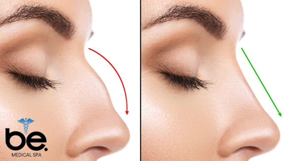 [Image: ¡Paga Q1,999 en Lugar de Q11,000 por Rinomodelación o Rejuvenecimiento Facial con Ácido Hialurónico + PRP + 1 Limpieza Facial Profunda + Microdermoabrasión + 1 Sesión de Lipólisis QUEMA GRASA CORPORAL!m]