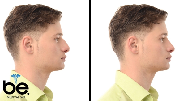 [Image: ¡Paga Q1,999 en Lugar de Q11,000 por Rinomodelación o Rejuvenecimiento Facial con Ácido Hialurónico + PRP + 1 Limpieza Facial Profunda + Microdermoabrasión + 1 Sesión de Lipólisis QUEMA GRASA CORPORAL!m]