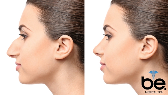 [Image: ¡Paga Q1,999 en Lugar de Q11,000 por Rinomodelación o Rejuvenecimiento Facial con Ácido Hialurónico + PRP + 1 Limpieza Facial Profunda + Microdermoabrasión + 1 Sesión de Lipólisis QUEMA GRASA CORPORAL!m]