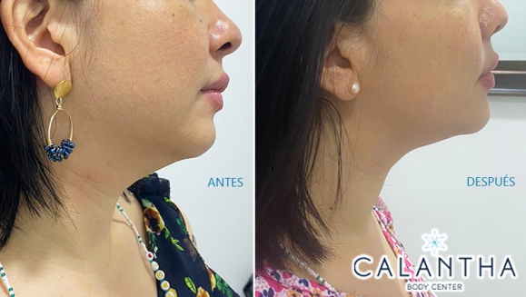 [Image: ¡Paga $99 en Lugar de $420 por 3 Sesiones para Reducción de Papada con: 3 Infiltraciones Múltiples con Cóctel de Enzimas + 3 Radiofrecuencias + 3 Masajes Linfáticos + Evaluación Médica!m]