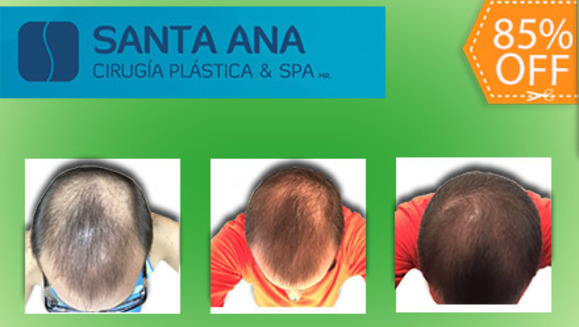 [Image: ¡Libérate YA de la pérdida de cabello! ¡Paga $200 en vez de $1350 por 3 Sesiones de Plasma Rico en Plaquetas para Alopecia (Calvicie) en Santa Ana Cirugía Plástica y Spa!m]