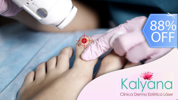 [Image: ¡Verano Libre de Hongos! Paga Q175 en vez de Q1,500 por Sesión Láser para Hongos en 2 Uñas del Pie en Clínica Dermatológica Kalyana!m]