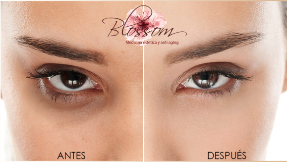 [Image: ¡Paga Q150 en lugar de Q750 por Reducción de Ojeras y Bolsas en Los Ojos con Terapia Intradérmica!m]