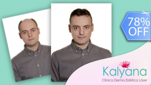 [Image: ¡Libérate de la pérdida de cabello! ¡Paga Q799 en vez de Q3,600 por Tratamiento contra  Alopecia (Calvicie) que incluye: 1 Sesión de Plasma Rico en Plaquetas + 3 Sesiones de Carboxiterapia + 3 Sesiones de Luz LED en Clínica Dermatológica Kalyana!m]
