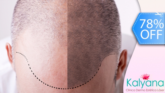 [Image: ¡Libérate YA de la Calvicie! ¡Paga Q699 en vez de Q3,125 por Paquete para Alopecia que incluye: 1 Sesión de Plasma Rico en Plaquetas + 2 Sesiones de Carboxiterapia + 1 Sesión de Luz LED roja en Clínica Dermatológica Kalyana!m]