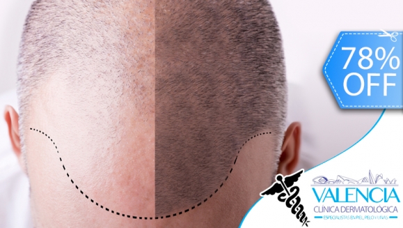 [Image: ¡Libérate de la Calvicie YA! ¡Paga Q699 en lugar de Q3,125 por Paquete para Alopecia que Incluye: 1 Sesión de Plasma Rico en Plaquetas + 2 Sesiones de Carboxiterapia + 1 Sesión de Luz LED Roja en Valencia Clínica Dermatológica!m]