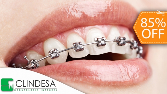 [Image: ¡Paga $85 en lugar de $550 por Colocación de Mini-Brackets Metálicos + Evaluación y Diagnóstico Odontológico en Clínicas Clindesa!m]