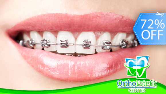 [Image: ¡Paga Q499 en lugar de Q1,800 por Colocación de Brackets Metálicos (Superiores e Inferiores) + Evaluación y Diagnóstico Clínico + Fotografías en Ortho Estetic!m]