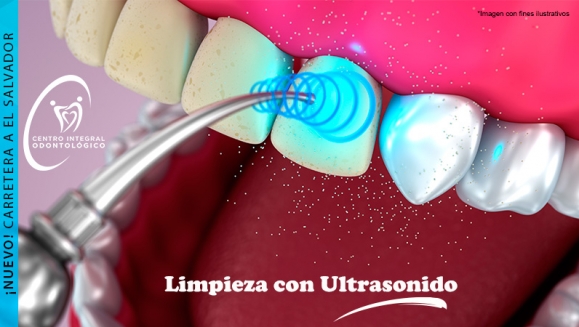 [Image: ¡Paga Q85 en lugar de Q500 por Limpieza Dental con Ultrasonido + Pulido Dental con Profijet + Aplicación de Flúor + Examen de Diagnóstico con Radiografías Digitales!m]