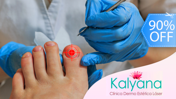 [Image: ¡Elimina los Hongos de las Uñas YA! ¡Paga Q75 en lugar de Q750 por Sesión Láser para Hongos en 1 Uña en Clínica Dermatológica Kalyana!m]