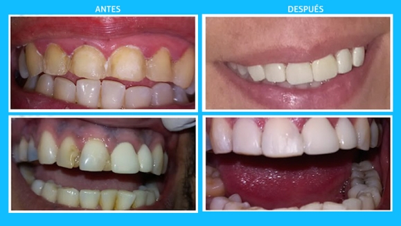 [Image: ¡Paga $25 en lugar de $75 por Reconstrucción De Dientes Frontales que Incluye: 2 Carillas Dentales de Resina Nano Híbrida de Porcelana y Zirconio + Limpieza Dental con Ultrasonido + Aplicación de Flúor!m]