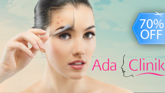 [Image: ¡Paga Q89 en lugar de Q300 por Facial Anti-Acné que Incluye: Limpieza Facial Profunda + Desinfección de Rostro + Peeling Médico en Ada Clinik!m]