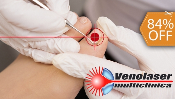 [Image: ¡Paga $39 en vez de $250 por Tratamiento Láser de 1 Sesión para 2 Uñas con Hongos en Venolaser!m]