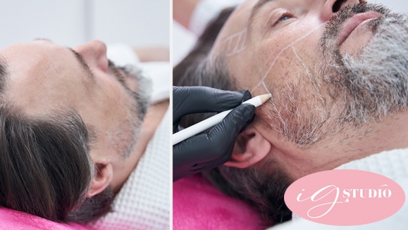 [Image: ¡Paga $65 en Lugar de $250 por Una Sesión de Microblading Capilar en el Área Frontal, Coronilla o Barba + Retoque!m]