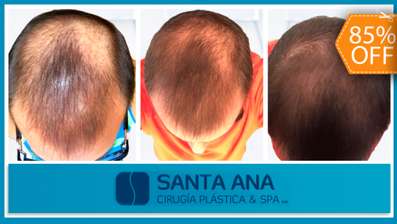 [Image: ¡Libérate YA de la pérdida de cabello! ¡Paga $200 en vez de $1350 por 3 Sesiones de Plasma Rico en Plaquetas para Alopecia con Factores de Crecimiento en Santa Ana Cirugía Plástica y Spa!m]