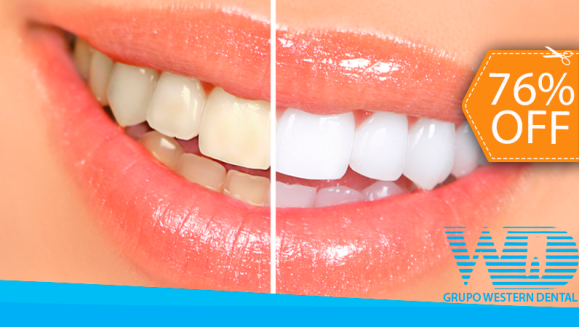 [Image: ¡Paga $79 en vez de $325 por 1 Sesión de Blanqueamiento Dental EXTREMO con sistema ZOOM + Limpieza con Ultrasonido en la Lujosa Sala VIP de Western Dental San Benito!m]