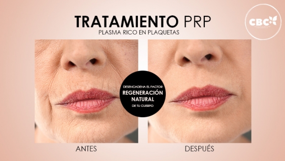 [Image: ¡Paga $199 en Lugar de $740 por 3 Sesiones de Plasma Rico en Plaquetas para Calvicie o Rejuvenecimiento Facial + 3 Limpiezas de Rostro + 3 Mascarillas de Ozono o Carbón Activado + 3 Microneedling + 6 Mascarillas Vampiro con Colágeno Puro y Más!m]