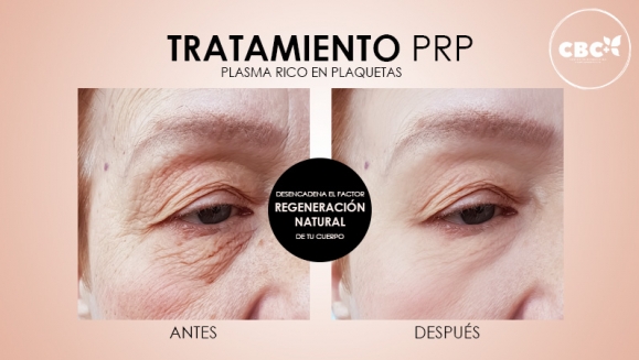 [Image: ¡Paga $199 en Lugar de $740 por 3 Sesiones de Plasma Rico en Plaquetas para Calvicie o Rejuvenecimiento Facial + 3 Limpiezas de Rostro + 3 Mascarillas de Ozono o Carbón Activado + 3 Microneedling + 6 Mascarillas Vampiro con Colágeno Puro y Más!m]