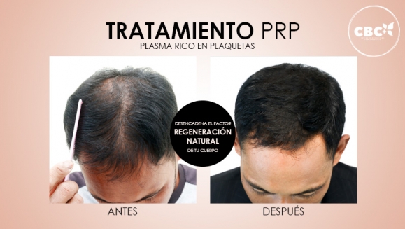 [Image: ¡Paga $199 en Lugar de $740 por 3 Sesiones de Plasma Rico en Plaquetas para Calvicie o Rejuvenecimiento Facial + 3 Limpiezas de Rostro + 3 Mascarillas de Ozono o Carbón Activado + 3 Microneedling + 6 Mascarillas Vampiro con Colágeno Puro y Más!m]