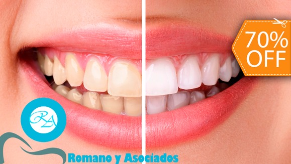[Image: ¡Paga $70 en lugar de $237 por Blanqueamiento Dental con Sistema Zoom + Limpieza con Ultrasonido + Diagnóstico con Cámara Intraoral + Revisión de Cordales en Clínica Médica Romano y Asociados!m]