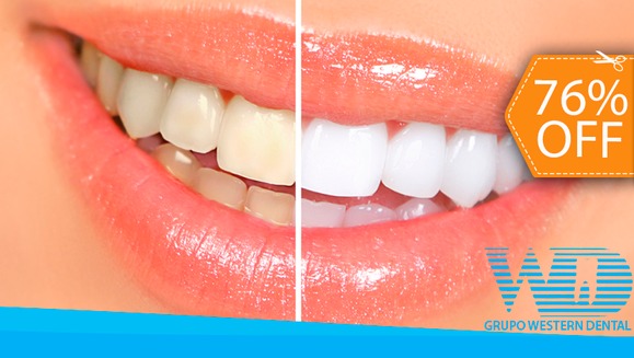 [Image: ¡Paga $79 en vez de $325 por 1 Sesión de Blanqueamiento Dental EXTREMO con sistema ZOOM + Limpieza con Ultrasonido!m]
