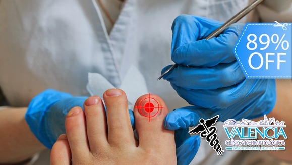 [Image: ¡Paga Q85 en lugar de Q750 por Sesión Láser para Eliminar Hongos en 1 Uña, Evaluación y Más!m]