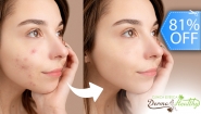 [Image: ¡Paga Q169 en Lugar de Q900 por Terapia Clínica Anti Acné: Luz Pulsada en 2 Puntos del Rostro + Alta Frecuencia + Exfoliación Suave + Extracción de Impurezas + Mascarilla Combinada Descongestiva y Desinfectante!m]