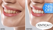 [Image: ¡Paga Q395 en Lugar de Q1,520 por Blanqueamiento Dental Químico con Luz LED + Desmanchado con Profilaxis + Limpieza con Ultrasonido + Evaluación Completa!m]